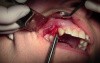 Lateral Ridge Augmentation #5 Site - Mineross And Ora-Mem