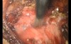Adhesive Complications in a Patient After Ventral Hernia IPOM Repair - Case 2