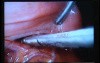 Jejunal Gastrointestinal Stromal tumor (GIST) (25 of 86)
