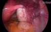 Cannulation for Tubal Block by Use of Hysteroscopy