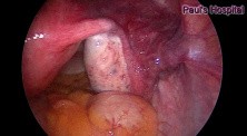 Cannulation for Tubal Block by Use of Hysteroscopy