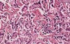 Cholangiocarcinoma, moderately well di - Histopathology - Liver
