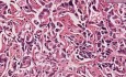 Cholangiocarcinoma, moderately well di - Histopathology - Liver