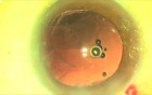 Fugo Plasma Ablation - Repair of Posterior Capsule Tear