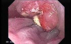 Esophageal Squamous Cell Carcinoma (1 of 2)