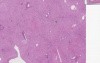 Cardiac cirrhosis - Histopathology of liver