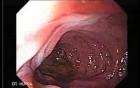 Larynx with Jaundice (3 of 6)