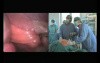 Laparoscopic Abdominal Hernia Repair with SILS® port – part 2