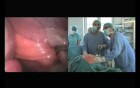 Laparoscopic Abdominal Hernia Repair with SILS® port – part 2