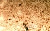 Endoscopy of Scirrhous Gastric Carcinoma involving the entire Fundus, Body and the Antrum (7 of 47)