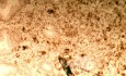 Endoscopy of Scirrhous Gastric Carcinoma involving the entire Fundus, Body and the Antrum (7 of 47)