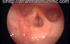 The Larynx (Voicebox) - The Absence of The Epiglottis (Lid)