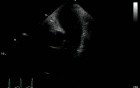 Pulmonary Trunk Thrombus