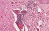 Poliomyelitis - Histopathology of skeletal muscle, spinal cord