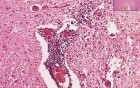 Poliomyelitis - Histopathology of skeletal muscle, spinal cord