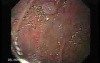 Brunner's Gland Adenoma (2 of 2)