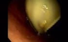 Endoscopic Balloon Removal (1 of 9)
