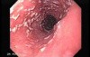Candidiasis - White Spots in the Esophagus
