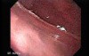 Early Gastric Cancer of the Gastroesophageal Junction - 83-Years Old Male