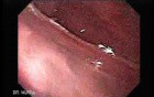 Early Gastric Cancer of the Gastroesophageal Junction - 83-Years Old Male