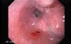 Esophageal Squamous Cell Carcinoma (3 of 3 )