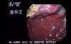 Adenocarcinoma of the Gastric Fundus