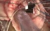 Operative Technique of Aortic Valve Replacement (2)