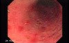 Colitis Ulcerosa - Pseudopolyps (16 of 22)