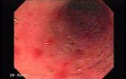 Colitis Ulcerosa - Pseudopolyps (16 of 22)