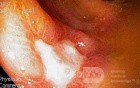 Cecal Ulcer induced by NSAID's