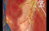 Decreased Blood Flow