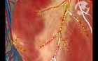 Decreased Blood Flow