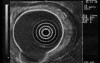 Scirrhous Gastric Carcinoma - Endoscopic Ultrasonography (9 of 15)