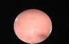 Cervix Obstructed By Intrauterine Adhesions - Hysteroscopic Treatment