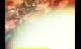 Olfactory groove meningioma-microsurgical excision
