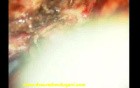 Olfactory groove meningioma-microsurgical excision