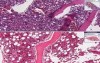 Adenocarcinoma, metastatic - Histopathology - Bone marrow