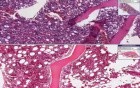 Adenocarcinoma, metastatic - Histopathology - Bone marrow