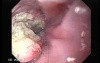 Esophageal Squamous Cell Carcinoma (2 of 5)