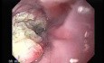 Esophageal Squamous Cell Carcinoma (2 of 5)
