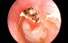 Left Ear Cholesteatoma with Attic Perforation