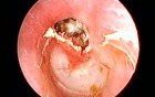 Left Ear Cholesteatoma with Attic Perforation
