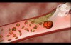 The Effect of Aspirin on Clot Formation