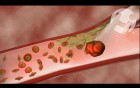 The Effect of Aspirin on Clot Formation
