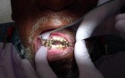 Check Mandibular Partial Denture Stability