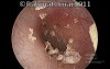 Epithelial Debris in Ear Canal From Desquamation