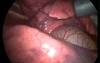 Video-Assisted Thoracoscopic Surgery 1/4