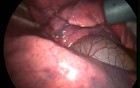 Video-Assisted Thoracoscopic Surgery 1/4