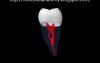 Mandibular Second Molar