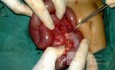 Gangrene Of The Intestine